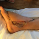 Illustration for article titled Snakebite Victims Post-Surgery Foot Is Still Horrifying (NSFW)